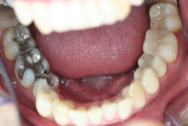 amalgamas-dentales-clinica-dental-gran-via-alicante-5