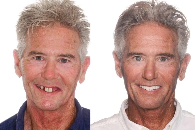 1-tecnica-all-on-four-implantes-dentales-alicante-clinica-dental-gran-via-alicante-dentista-alicante-clinica-dental-alicante