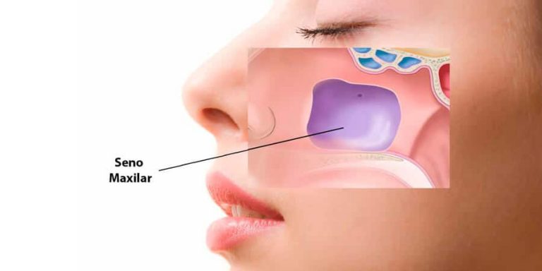 injerto-osea-elevacion-del-seno-maxilar-clinica-dental-gran-via-alicante-clinica-dental-alicante-dentista-alicante-5