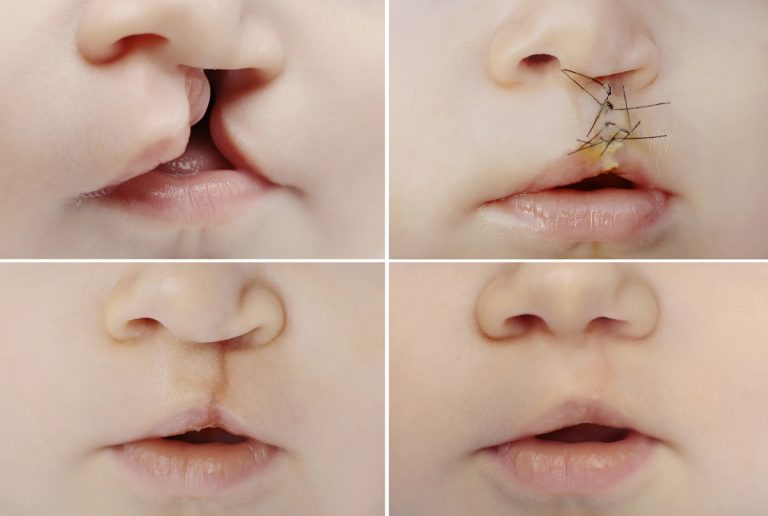 Labio-leporino-y-paladar-hendido-clinica-dental-gran-via-alicante-dentista-alicante