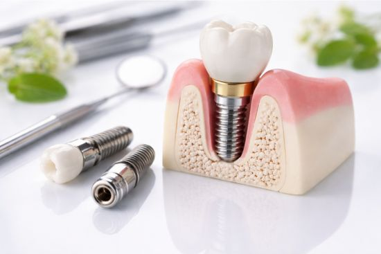clinica implante dental alicante