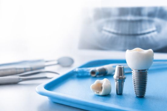 implante dental alicante