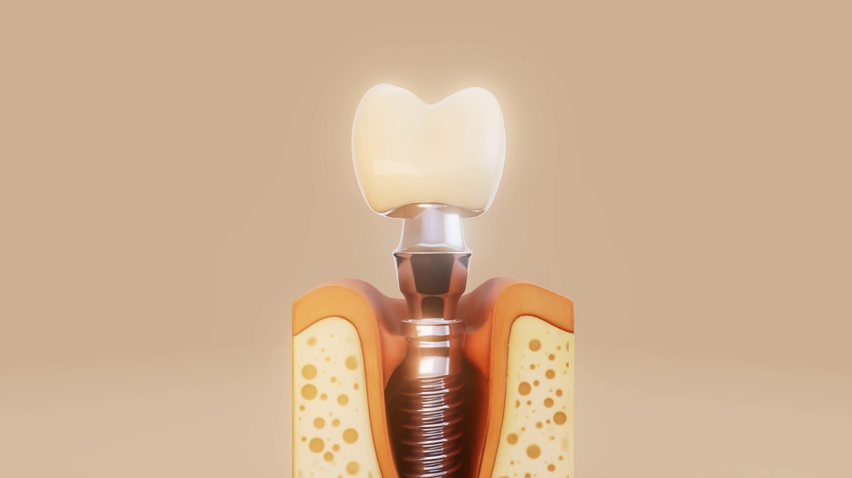 alergia-al-titanio-dental-clinica-dental-gran-via-alicante-dentista-alicante-clinica-dental-alicante (1)