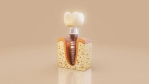 alergia-al-titanio-dental-clinica-dental-gran-via-alicante-dentista-alicante-clinica-dental-alicante (1)