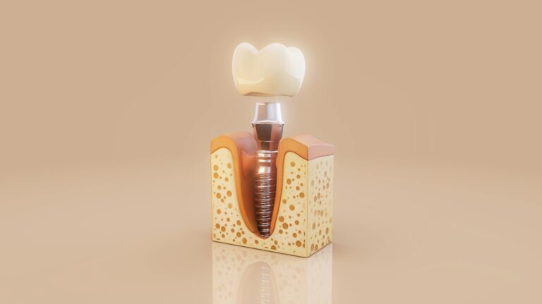alergia-al-titanio-dental-clinica-dental-gran-via-alicante-dentista-alicante-clinica-dental-alicante (1)