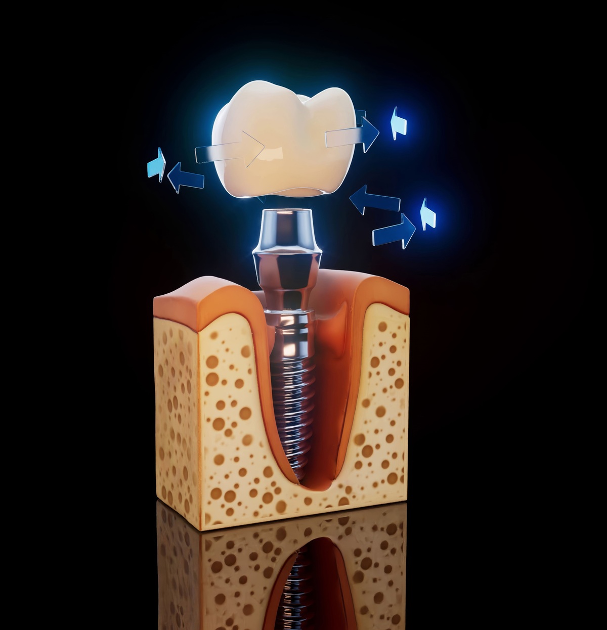 alergia-al-titanio-dental-clinica-dental-gran-via-alicante-dentista-alicante-clinica-dental-alicante (1)