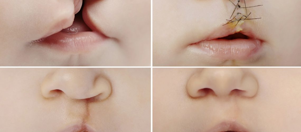 Labio-leporino-y-paladar-hendido-clinica-dental-gran-via-alicante-dentista-alicante