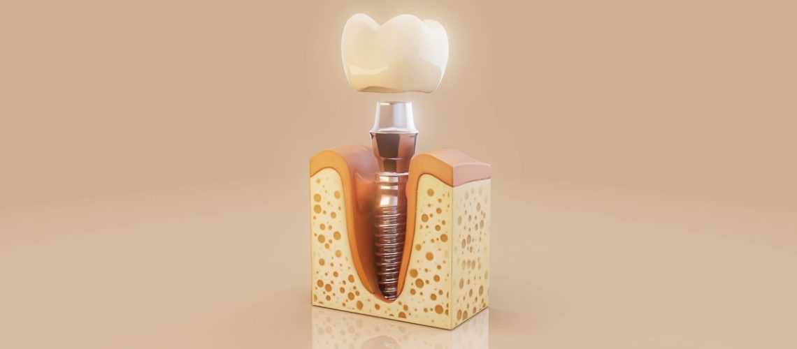 alergia-al-titanio-dental-clinica-dental-gran-via-alicante-dentista-alicante-clinica-dental-alicante (1)