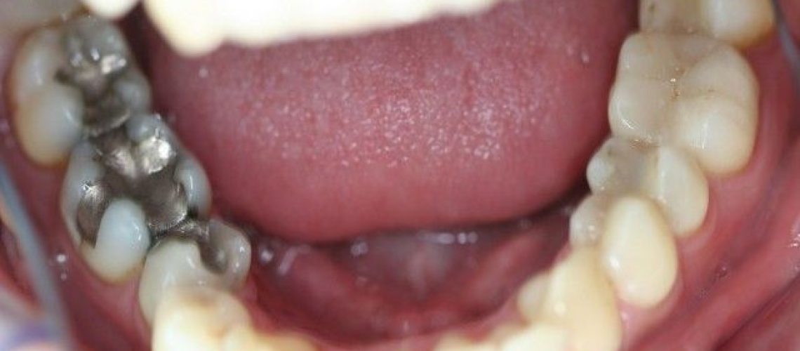 amalgamas-dentales-clinica-dental-gran-via-alicante-5