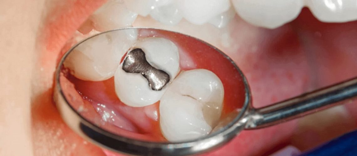 riesgos del empaste de amalgama