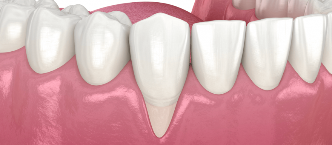 encía-retraída-clinica-dental-alicante-clinica-dental-gran-via-alicante-dentista-alicante (2)