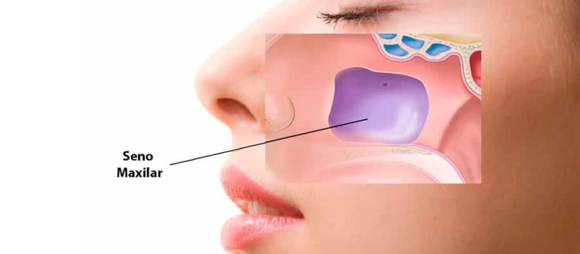 injerto-osea-elevacion-del-seno-maxilar-clinica-dental-gran-via-alicante-clinica-dental-alicante-dentista-alicante-5